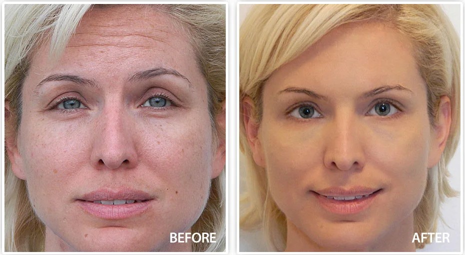 Woman applying anti aging skincare for sensitive skin in morning routine