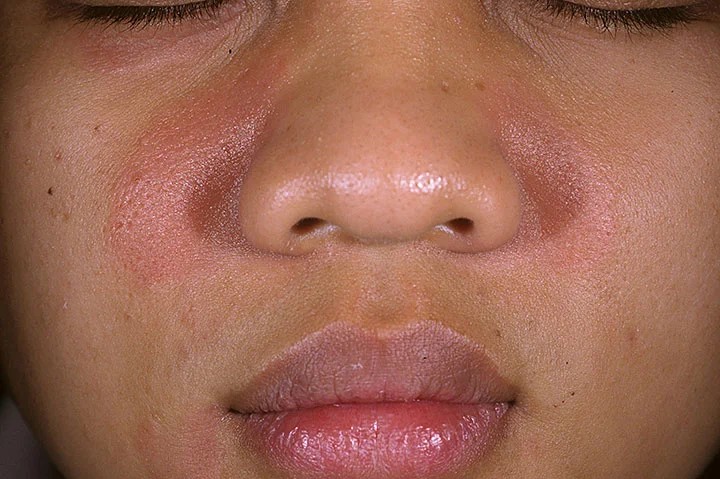 Best cream for seborrheic dermatitis on face in jar with gentle formula