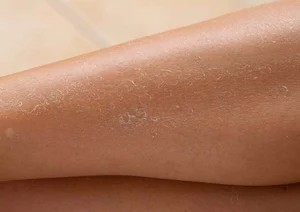 Common causes of dry skin on the legs including weather, shaving and skin conditions