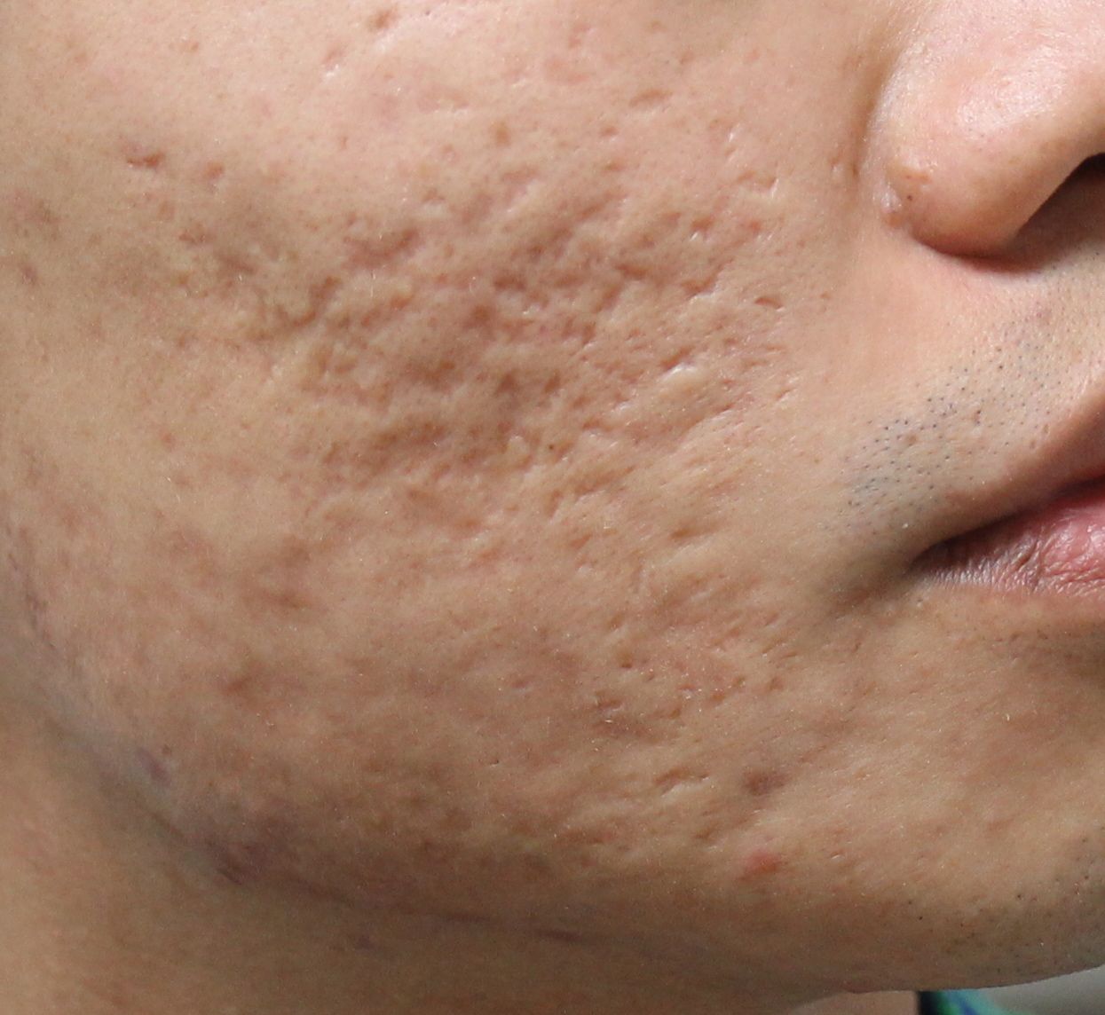 how can you get rid of acne scars naturally before and after results