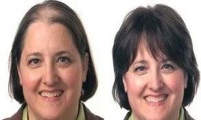 How to Stop Losing Hair in the Shower: Causes and Proven Solutions 2 Before and after results showing improvement after reducing hair loss in the shower