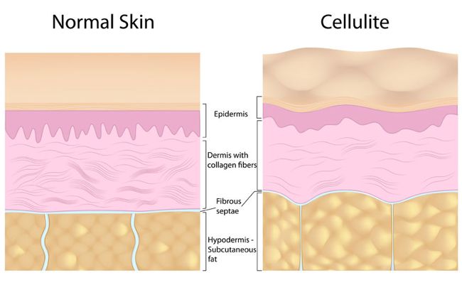 Comparison between normal skin and cellulite on legs