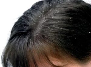Severe dandruff flakes on scalp before washing hair